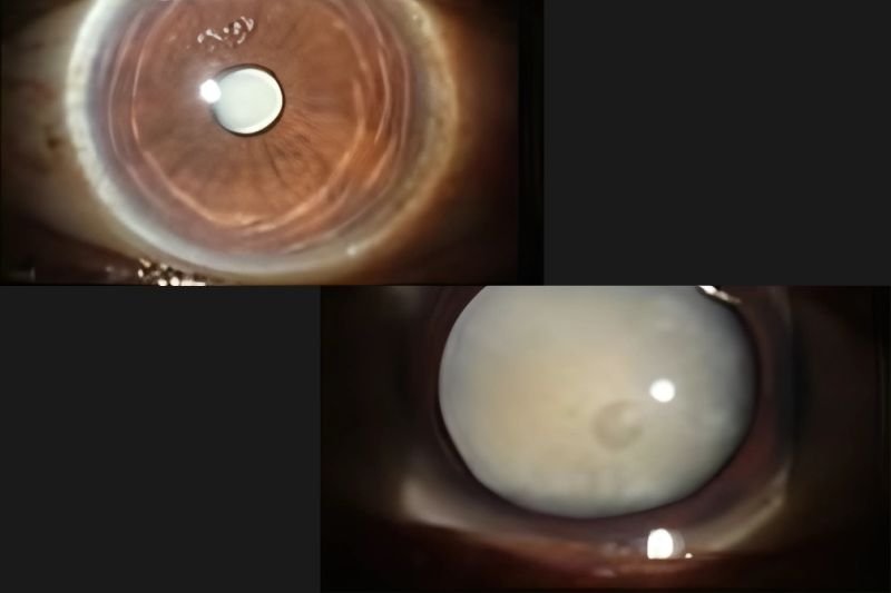 Cataract Management