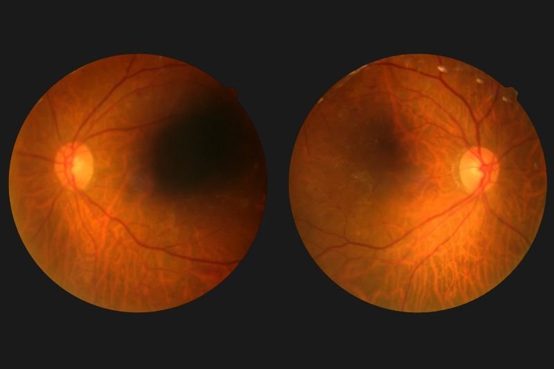 Diabetic Retinopathy Screening