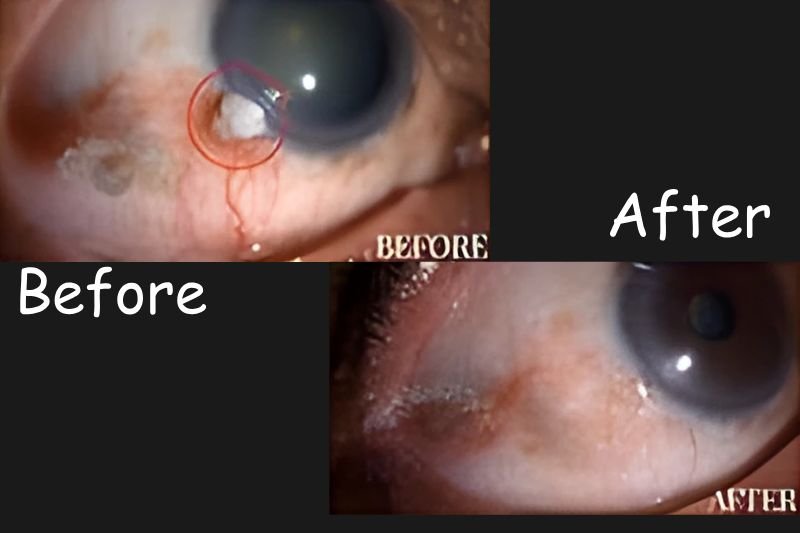 Ocular Oncology