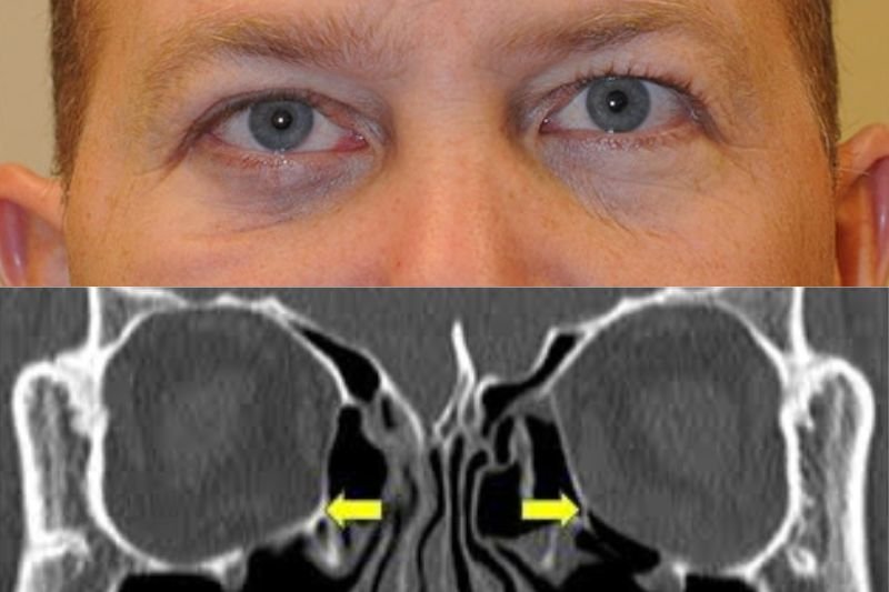 Orbital Fracture Repair