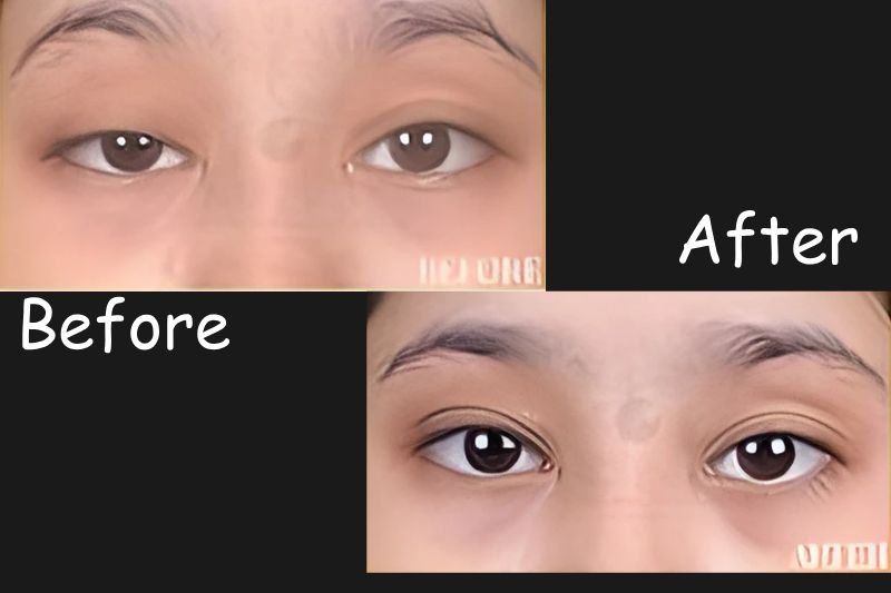 Ptosis