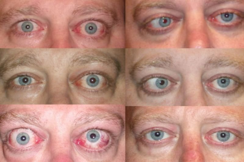 Thyroid Eye Disease