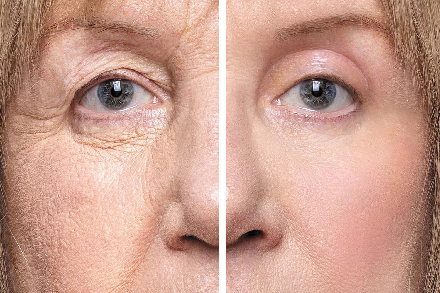 Blepharoplasty in Nagpur