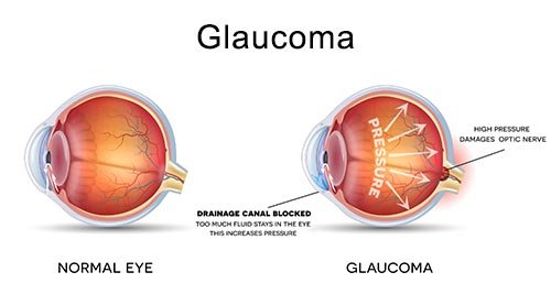 Glaucoma specialist in Nagpur