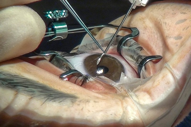 Glaucoma surgery in Nagpur