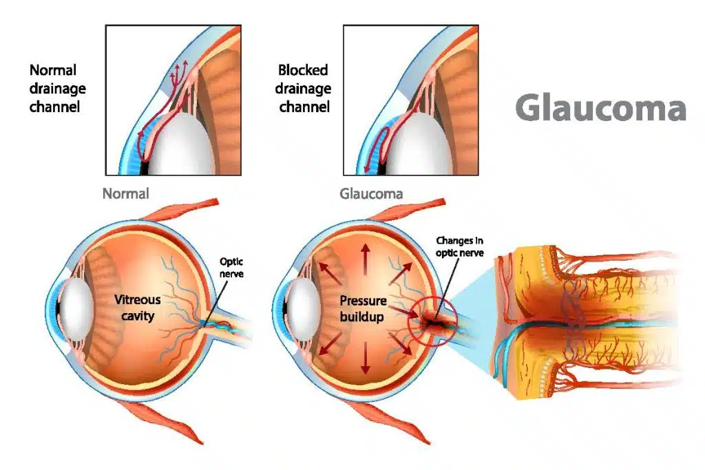 Glaucoma treatment in Nagpur