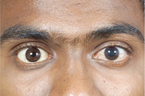 Artificial eye in Nagpur