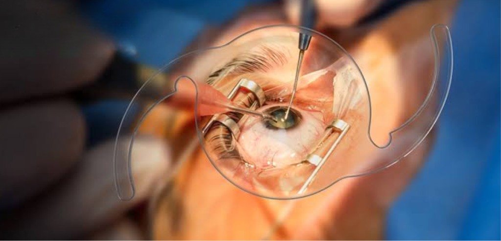 Cataract Surgery in Nagpur