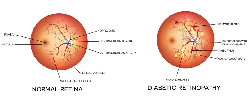 Diabetic retina specialist in Nagpur