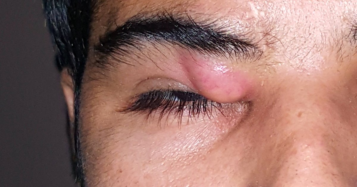 Eye cancer specialist in Nagpur
