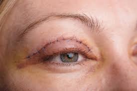 Eyelid surgery in Nagpur