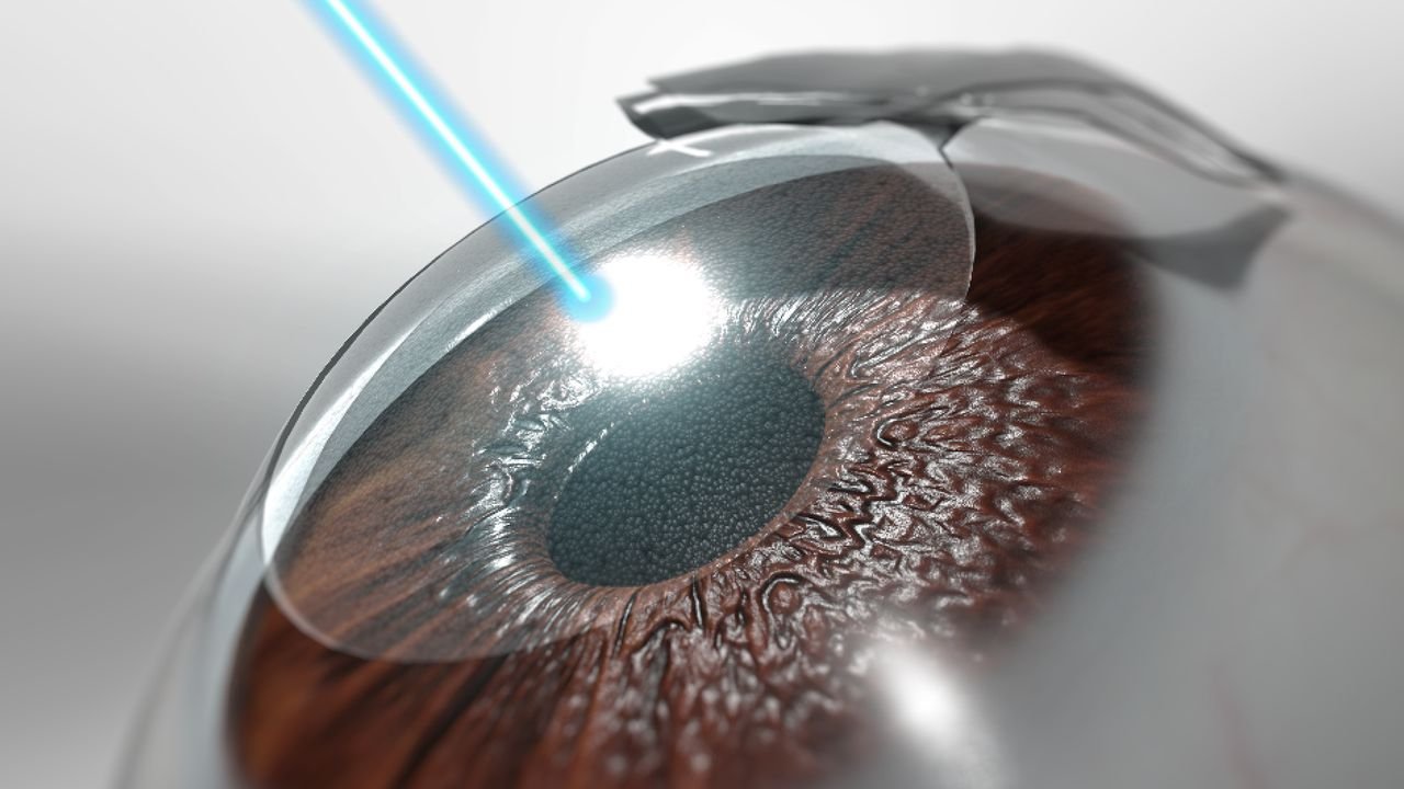 LASIK surgery in Nagpur