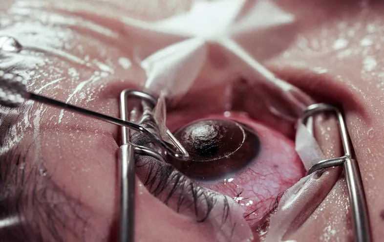 Laser eye surgery in Nagpur