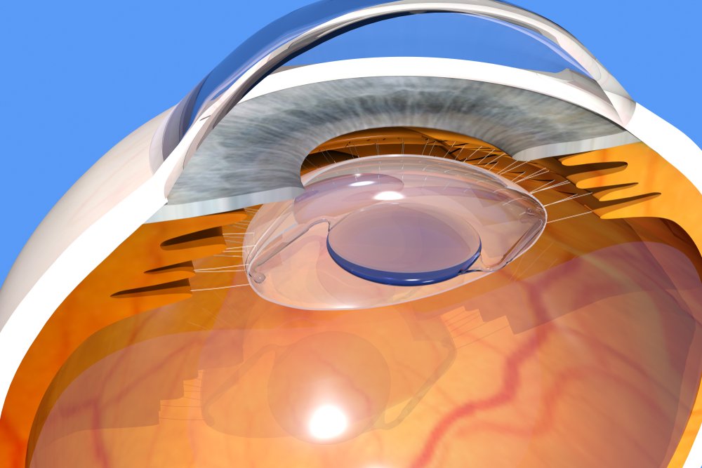 Premium cataract surgery in Nagpur