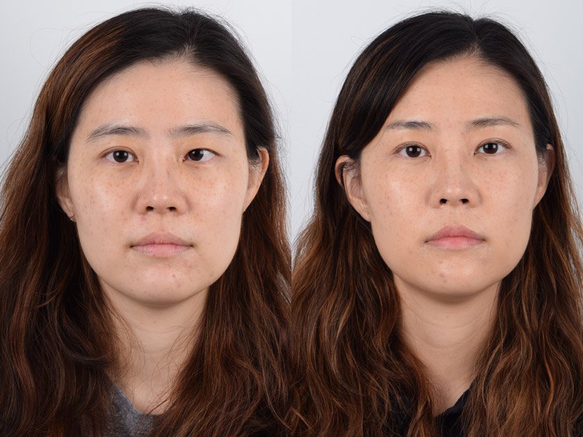 Ptosis surgery in Nagpur