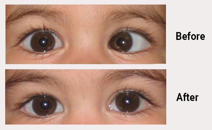 Squint specialist in Nagpur