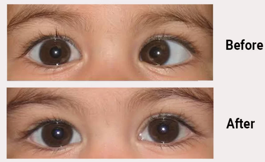 Squint surgery in Nagpur