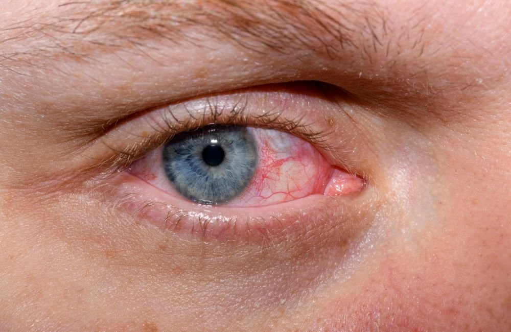 Watering of eyes treatment in Nagpur